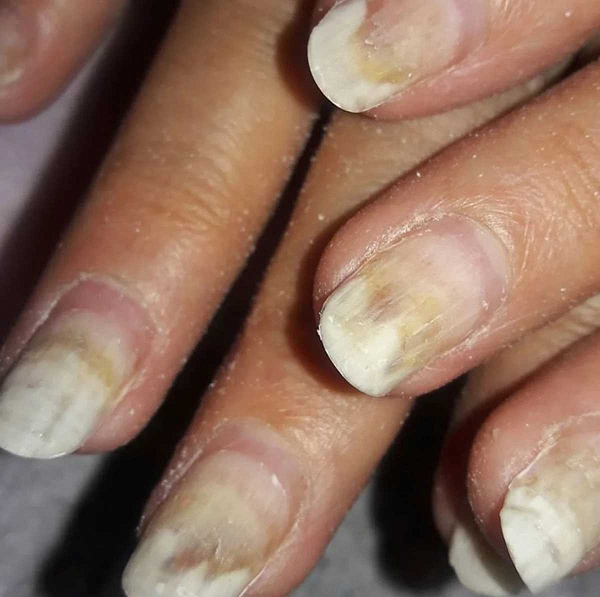 как вылечить ногти после гель лака