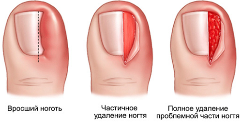 лечение вросшего ногтя у подолога
