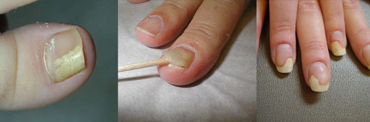 онихолизис ногтей лечение профилактика