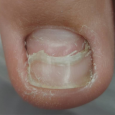 Онихомадезис – еще одно заболевание ногтей, которое стало встречаться чаще.
