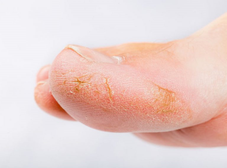 трещины на коже пальцев ног
